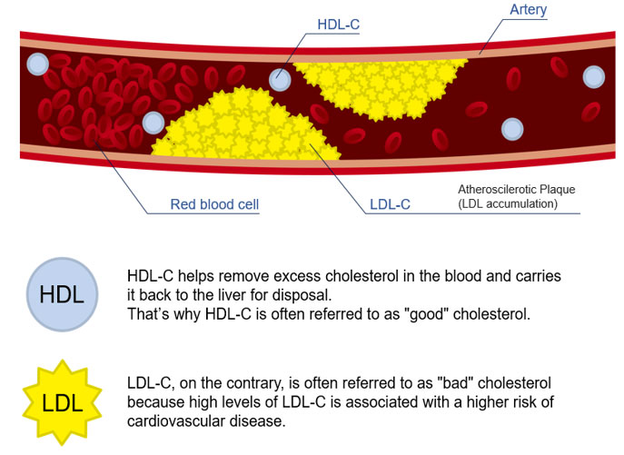 HDL-C helps remove excess cholesterol in the blood and carries it back to the liver for disposal.That’s why HDL-C is often referred to as good cholesterol.LDL-C, on the contrary, is often referred to as bad cholesterol because high levels of LDL-C is associated with a higher risk of cardiovascular disease.